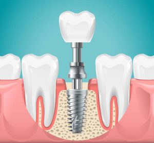 Dental implants in Perth WA